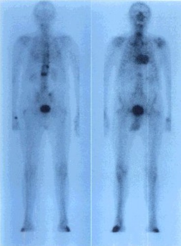 Obr. . 1: Celotlov scintigrafie skeletu v zadn a pedn projekci