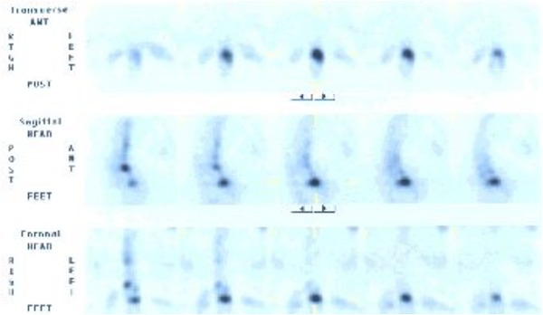 Obr. . 2: SPECT hrudn a bedern ptee