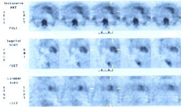 Obr. . 3: SPECT hrudnku-zobrazen myokardu