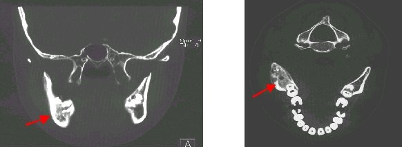 Obr. . 1: CT doln elisti