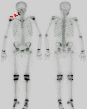 Obr. . 3: Scintigrafie skeletu