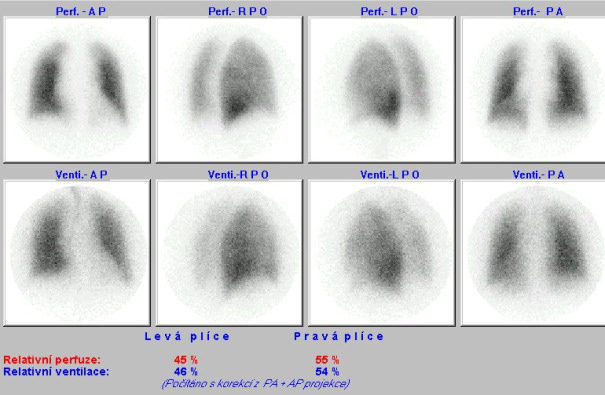 Obr. . 1: Kombinovan perfuzn a ventilan scintigrafie plic na planrn kamee