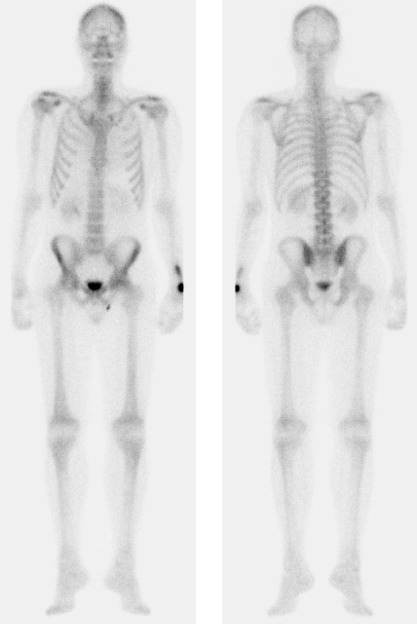 Obr. č. 2: Celotělová scintigrafie skeletu v přední a zadní projekci