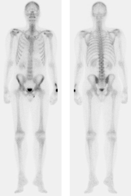 Obr. . 2: Celotlov scintigrafie skeletu v pedn a zadn projekci