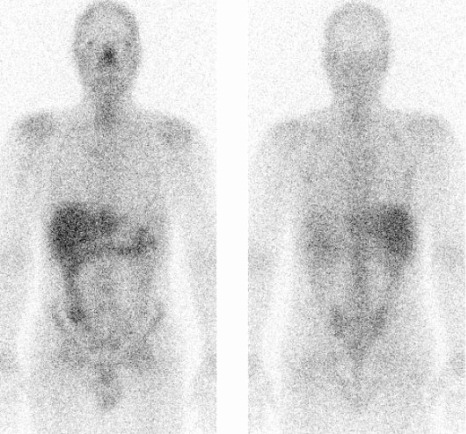 Obr. . 4: Celotlov scintigrafie po aplikaci glium citrtu v pedn a zadn projekci za 96 hodin po aplikaci