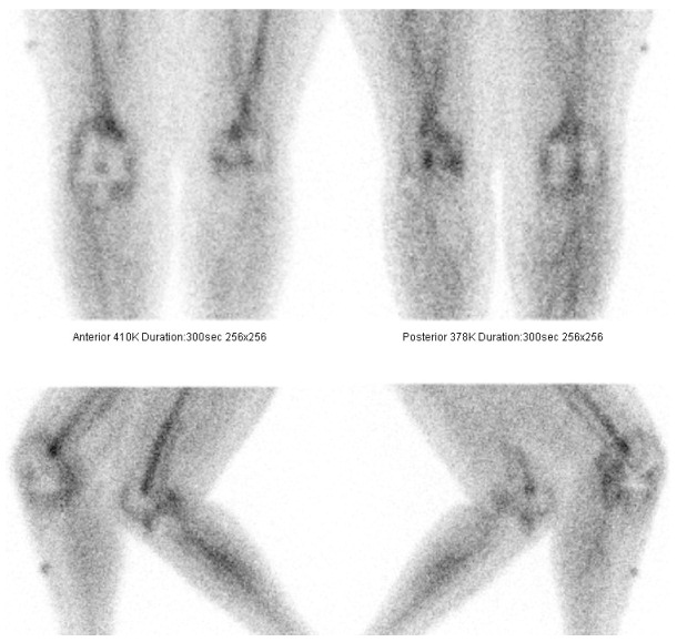 Obr. . 5: Statick scintigramy kolennch kloub 2 hod. po podn LeukoScanu v pedn, zadn a bonch projekcch
