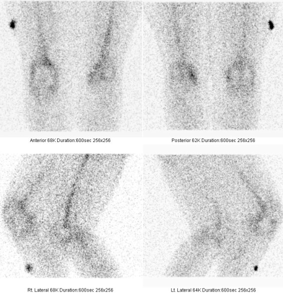 Obr. č. 6: Statické scintigramy kolenních kloubů 24 hod. po podání LeukoScanu v přední, zadní a bočních projekcích