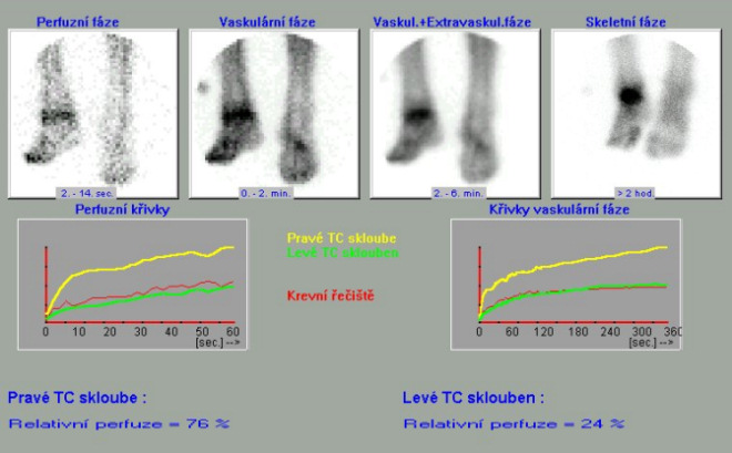 Obr. č. 1: Třífázová scintigrafie skeletu – 1. fáze (perfuze) , 2. fáze tkáňová ( tzv. blood pool) a 3. pozdní kostní fáze. Scintigrafie nohou a distálních částí bérců po aplikaci radiofarmaka 99mTc-oxidronátu v přední projekci. Dole histogramy z ROI vymezenými nad oběma talokrurálními klouby a nad krevním řečištěm