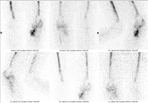Obr. č. 5: Statická scintigrafie zánětu za 24 hod. po aplikaci značených monoklonálních protilátek proti granulocytům, projekce přední, zadní a obě boční