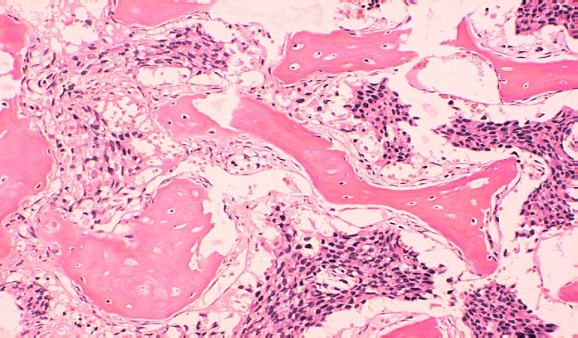 Obr.2. Parafínový řez z trepanobiopsie kostní metastázy, zvětšeno 125x, barvení HE, kde růžově jsou zobrazeny kostní trámce s osteoplastickým charakterem a mezi nimi jsou patrné úseky tumorózních světlých buněk s tmavými jádry.