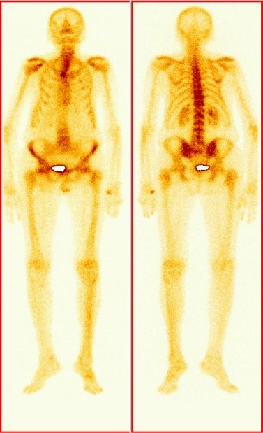 scintigrafie skeletu prostata