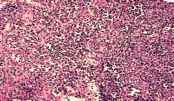 Obr.7. Parafínový řez metastázy v uzlině, zvětšeno 50x, barvení HE, kde mezi proužky vazivového stromatu jsou patrné světlé nádorové buňky s tmavými jádry.