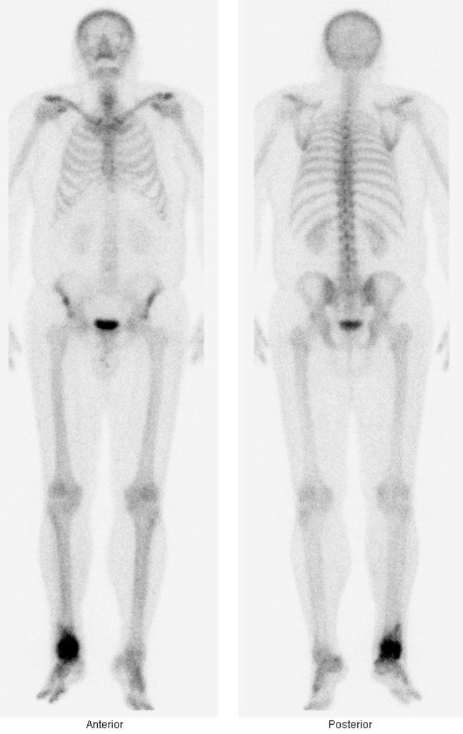 Obr. č. 2: Třífázová scintigrafie skeletu – 3., pozdní kostní fáze. Celotělová scintigrafie 3 hodiny po aplikaci radiofarmaka 99mTc-oxidronátu v přední a zadní projekci