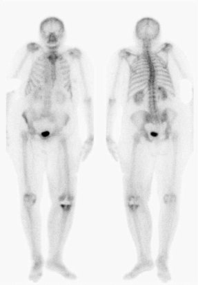 Obr. č. 1: Celotělové scintigramy skeletu v přední a zadní projekci