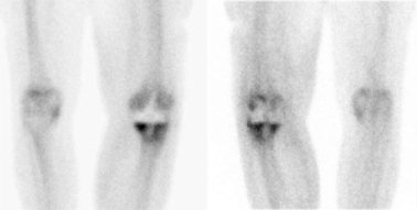 Obr. č. 2: Statické scintigramy kolenních kloubů v přední a zadní projekci