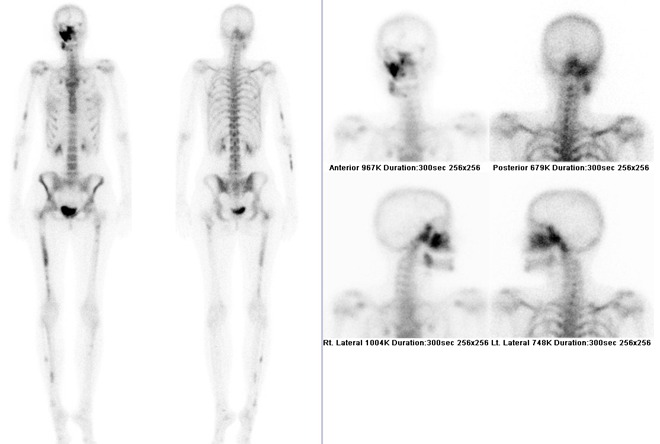 Obr. č. 1: Celotělová scintigrafie skeletu v přední a zadní projekci kombinovaná se statickou scintigrafií lebky