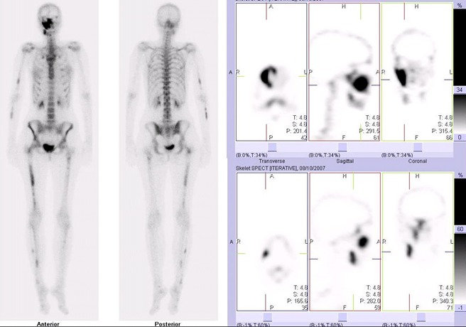 Obr. č. 2: Celotělová scintigrafie skeletu v přední a zadní projekci