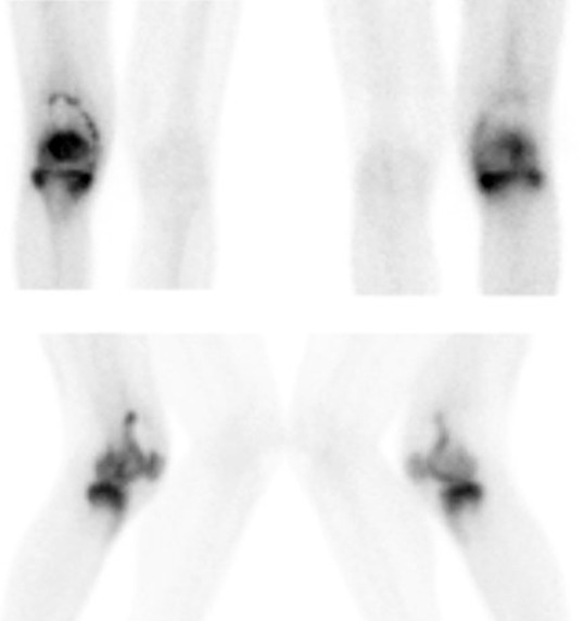 Obr. č. 3: Třífázová scintigrafie skeletu – 3., pozdní kostní fáze