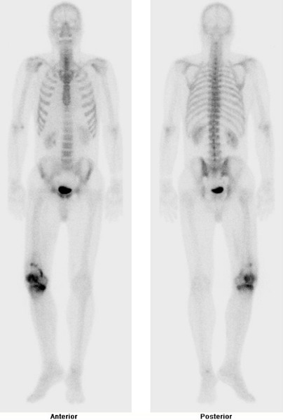 Obr. . 4: Celotlov scintigrafie skeletu v pedn a zadn projekci