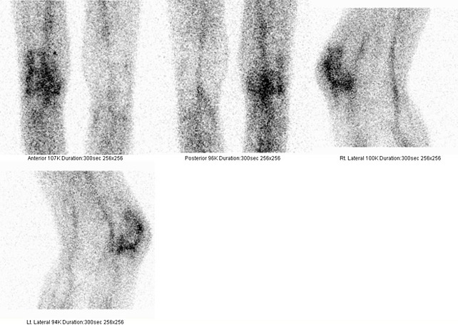 Obr. . 6: Statick scintigrafie zntu za 4 hod. po aplikaci znaench monoklonlnch protiltek proti granulocytm, projekce pedn, zadn a ob bon- scintigrafie obou kolenou