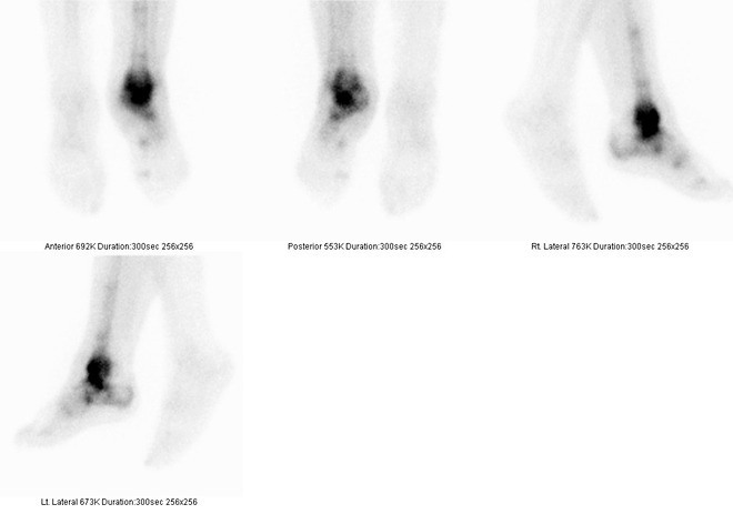 Obr. . 2: Tfzov scintigrafie skeletu  3., pozdn kostn fze.