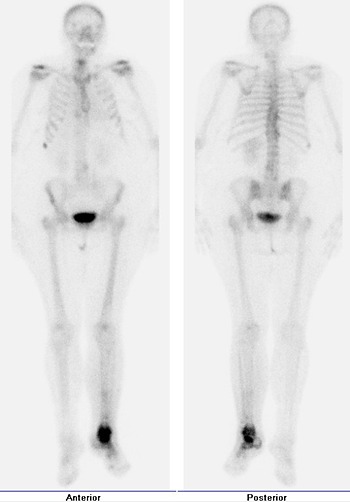 Obr. . 3: Celotlov scintigrafie skeletu v pedn a zadn projekci