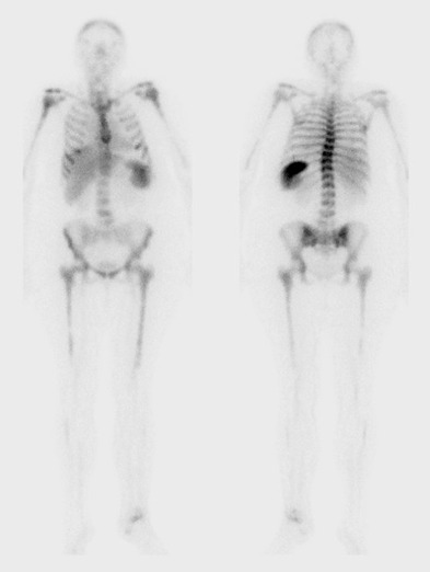 Obr. . 4: Celotlov scintigrafie zntu za 4 hod. po aplikaci znaench