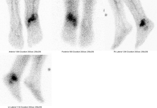 Obr. . 5: Statick scintigrafie zntu za 4 hod. po aplikaci znaench monoklonlnch protiltek proti granulocytm