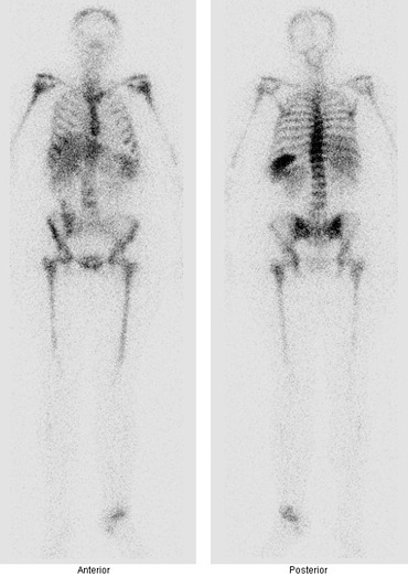 Obr. . 6: Celotlov scintigrafie zntu za 24 hod. po aplikaci znaench monoklonlnch protiltek