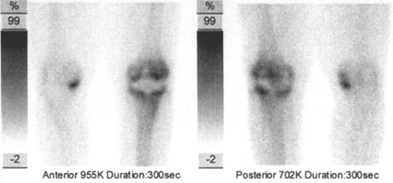 Obr. . 3: Tfzov scintigrafie skeletu  3., pozdn kostn fze