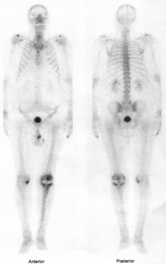 Obr. . 4: Celotlov scintigrafie skeletu v pedn a zadn projekci