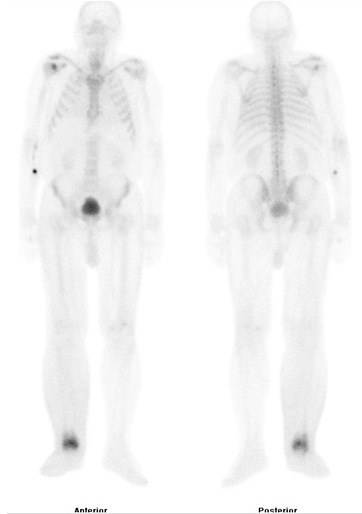 Obr. . 2: Celotlov scintigrafie skeletu v pedn a zadn projekci