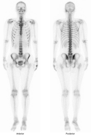 Obr. . 1: Celotlov scintigramy skeletu v pedn a zadn projekci