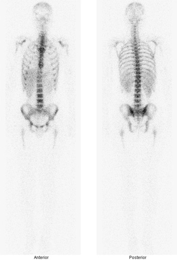 Obr. . 6: Celotlov scintigrafie zntu za 24 hod. po aplikaci znaench monoklonlnch protiltek