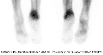 Obr. . 2: Tfzov scintigrafie skeletu  2. fze tkov (tzv. blood pool)