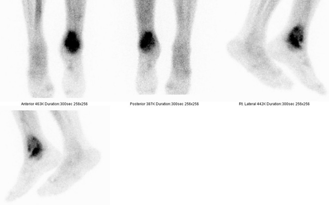 Obr. . 3: Tfzov scintigrafie skeletu  3. pozdn kostn fze