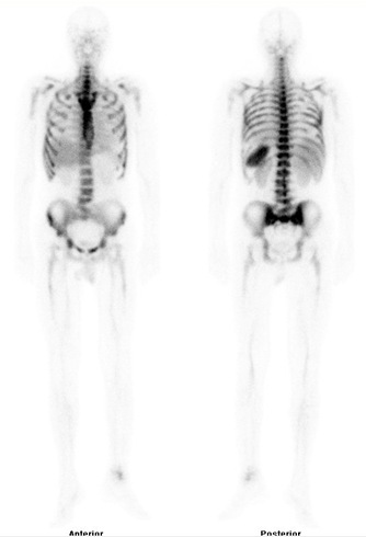 Obr. . 4: Celotlov scintigrafie zntu za 4 hod. po aplikaci znaench monoklonlnch protiltek