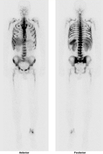 Obr. . 6: Celotlov scintigrafie zntu za 24 hod. po aplikaci znaench monoklonlnch protiltek