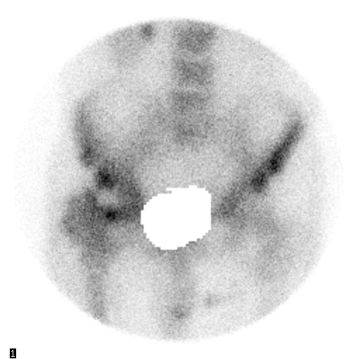 Obr. 3:  3. fáze: snímek za 2 hod: fotopenická laese v hlavici kosti stehenní vpravo