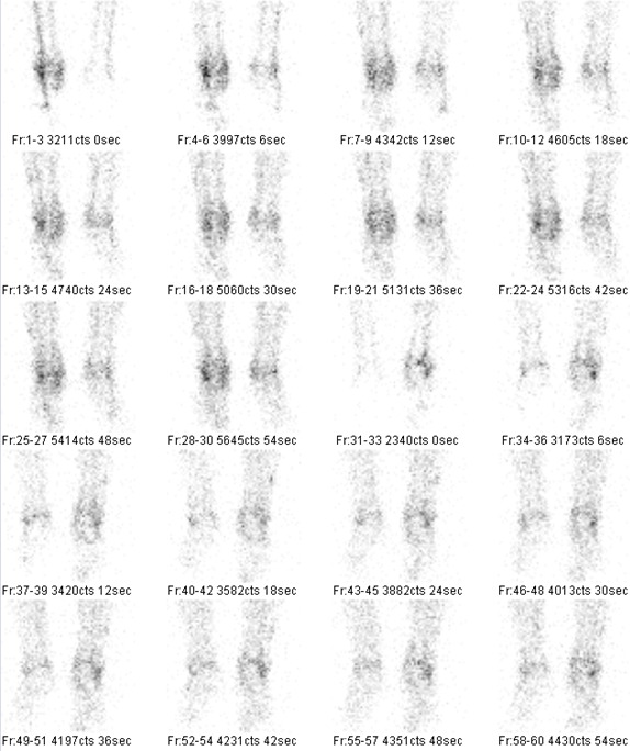 Obr. . 1: Tfzov scintigrafie skeletu  1. fze perfuzn