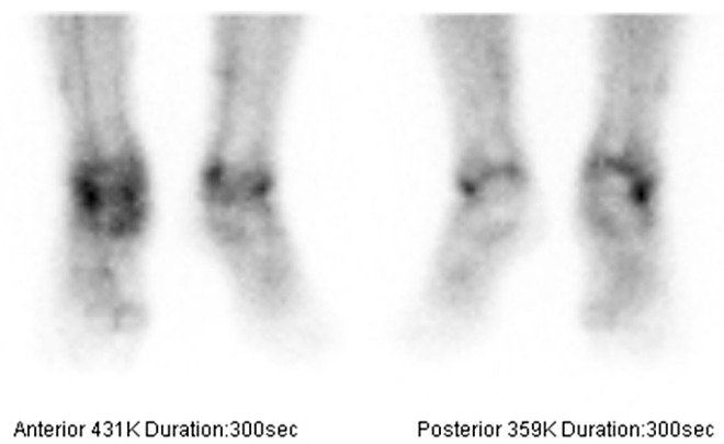 Obr. . 2: Tfzov scintigrafie skeletu  2. fze tkov