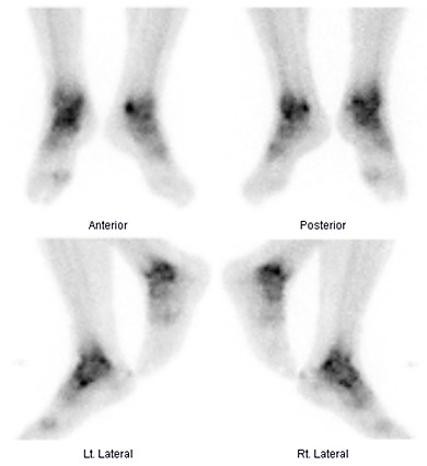 Obr. . 3: Tfzov scintigrafie skeletu  3. pozdn kostn fze