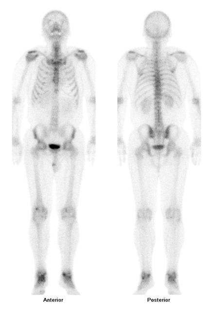 Obr. . 4: Celotlov scintigrafie skeletu v pedn a zadn projekci