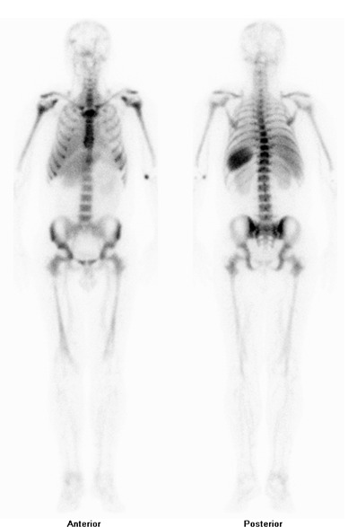 Obr. . 5: Celotlov scintigrafie zntu