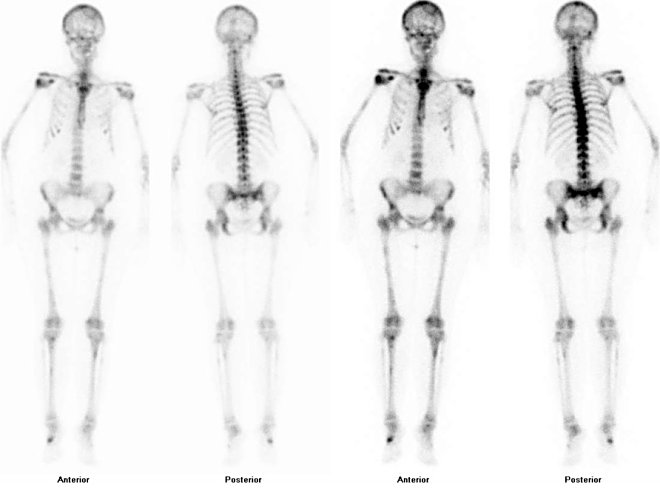 Obr. . 1: Celotlov scintigrafie skeletu v pedn a zadn.