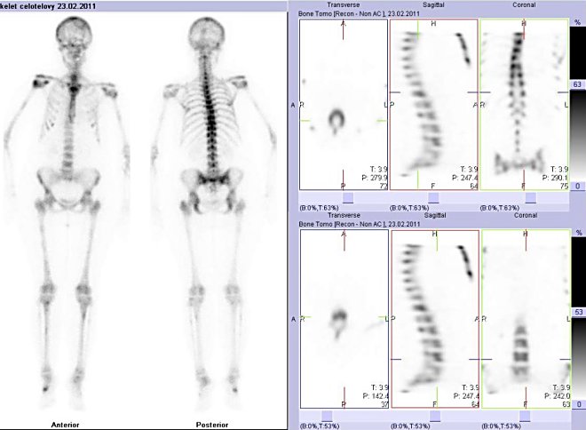 Obr. . 2: Celotlov scintigrafie a tomografick scintigrafie (SPECT) skeletu L a doln Th ptee. Vpravo v hornm i dolnm dku ezy transverzln, ezy sagitln a ezy koronln.