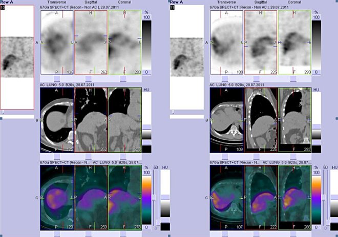 Obr. . 2: Fze obraz SPECT a CT. Vyeten 72 hod. po aplikaci radioindiktoru. Vlevo i vpravo zameno na dv mal loiska v pravm jaternm laloku patrn pouze na CT. Nahoe vdy obrazy SPECT, uprosted CT, dole fze obraz SPECT a CT.