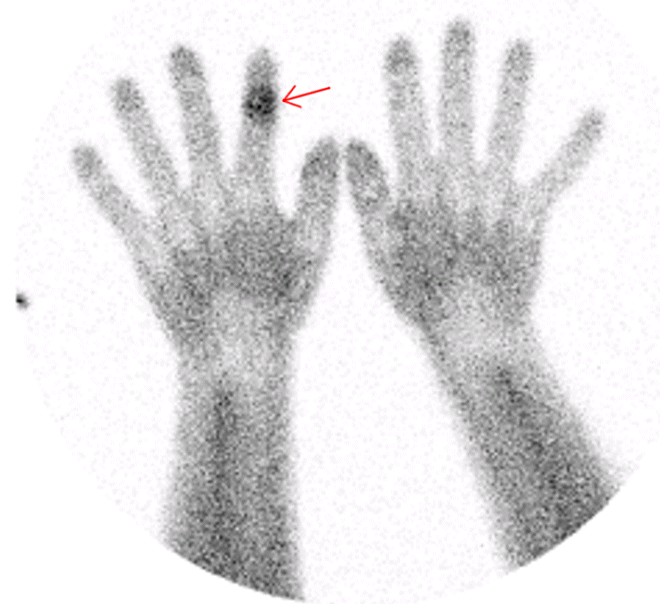 Obr. . 2: Scintigrafie kosti 99mTc MDP loisko se zvenou perfuz ve stednm lnku ukazovku prav ruky  fze blood poolu.