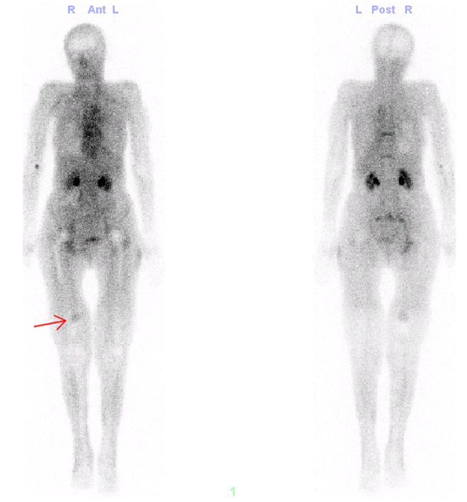 Obr. . 1: Fze blood poolu pi celotlovm zobrazen skeletu v AP a PA projekci - patrn kulovit loisko zven perfuse v distln tetin pravho stehna mediln v povod a. femoralis l.dx.