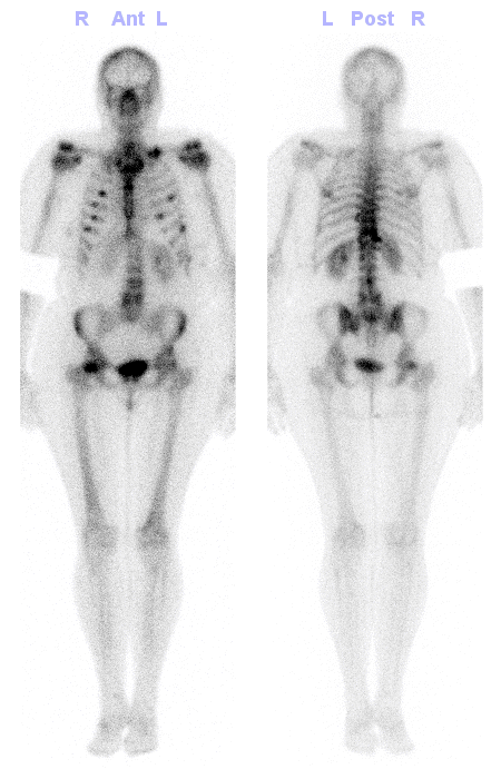 Obr. . 2: Celotlov scintigrafie skeletu v kostn fzi vyeten  mnohoetn loiska zven kostn pestavby ve ve uvedench lokalizacch.